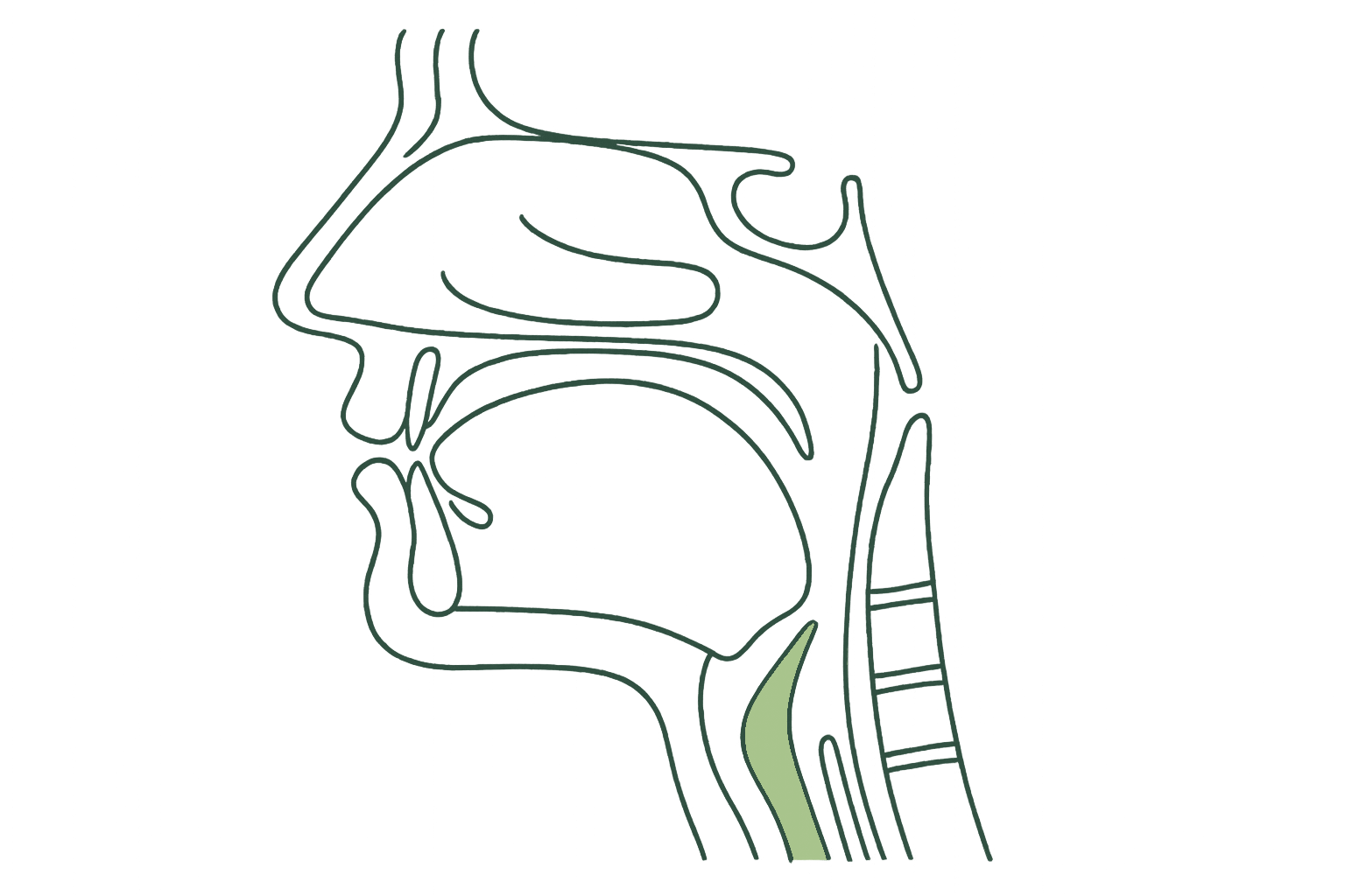 A narrowed, collapsing airway during sleep