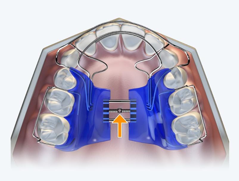 Biobloc Treatment: Guiding Facial Growth for Healthier Development